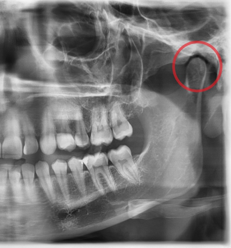 TMJ / TMD - Dentist West Edmonton - Copperwood Dental TMJ / TMD - Dentist West Edmonton - Copperwood Dental