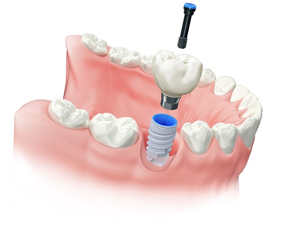 Implants - Dentist West Edmonton - Copperwood Dental Implants - Dentist West Edmonton - Copperwood Dental
