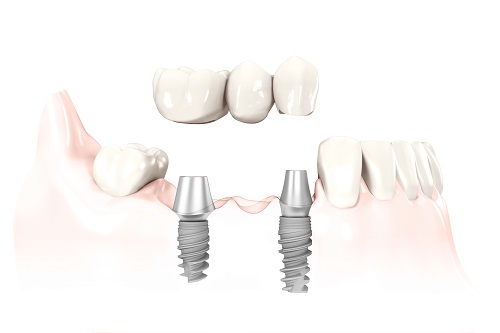 Implants - Dentist West Edmonton - Copperwood Dental Implants - Dentist West Edmonton - Copperwood Dental